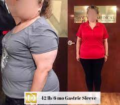 Because the new stomach continues to function normally there are far fewer restrictions on the foods which patients can consume after surgery, albeit that the quantity of. Gastric Sleeve Surgery In Los Angeles