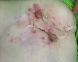 Persistent and worsening pain, such as chest, back or hip pain Dermoscopy Of Skin Metastases From Breast Cancer Two Case Reports Journal Of Medical Case Reports Full Text
