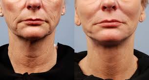 Non Surgical Facelift Toronto See Our Before Afters