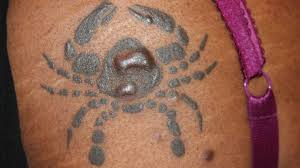 They're a possibility, never a certainty. Keloid Tattoo When Scars Form Tattooing Over Keloids More