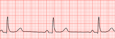 Bradycardia Wikipedia