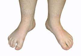 Kondisi di mana ada urat yang melentur ke dalam pada kaki kita, sehingga membentuk seperti huruf x. Jenis Jenis Kelainan Tulang Dan Sendi Pada Kaki Anak Orang Tua Wajib Tahu Klinik Tulang Belakang