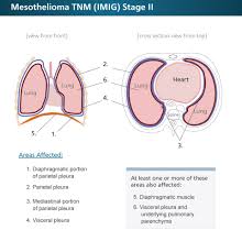 Pin On Tumor