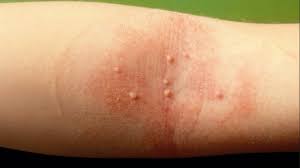 molluscum contagiosum qu est ce que c est peut il aller a la piscine pediatre online