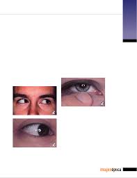 Adaptación de lented de contacto esfericos