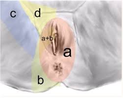 Cluneal nerve entrapment myofascial release. Pudendal Neuralgia Glowm
