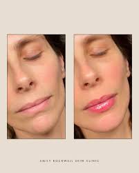 swipe for some of @kelseythroppaesthetics beautiful work!😍🤍 ready for  your next treatment? head to the link in our bio to book with kelsey!  #skintransformation #injectables #cosmeticinjectables  #emilyrockwellskinclinic #booknow #skinclinics ...