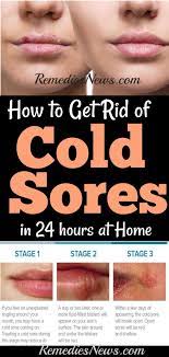 How To Get Rid Of Cold Sores Fast In 24 Hours At Home 11 Best Home Remedies To Treat Cold Sore On Lips And Cold Sore Natural Cold Sore Remedy