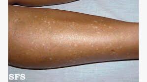 Image result for liver spots on legs