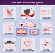 Image result for IDSA Diabetic Foot Wound Classification
