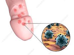 Image result for genital herpes