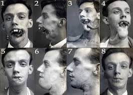 In An Era Before Antibiotics Facial Reconstructions Were Accomplished Via The Waltzing Tube Pedicle Technique Pioneere History Vintage Medical Medical History