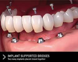 We did not find results for: Dental Bridges Why Choose A Dental Bridge Over A Dental Implant