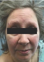 Chronic lymphocytic leukemia skin infiltrates presenting as eyebrow  alopecia and erythematous pruritic papules refractory to treatment with  topical steroids