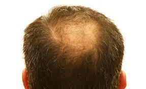 The 8 Best Hair Loss Concealers Hair Fibers Reviewed 2021