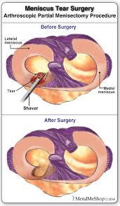 Meniscus Surgery Post Operative Rehabilitation Meniscectomy Meniscus Surgery Arthroscopic Knee Surgery Meniscus Tear