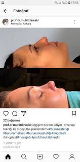 Burun Estetigi Ankara Kadinlar Kulubu