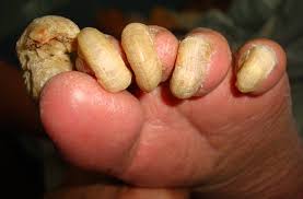 Image result for Onychogryphosis feet