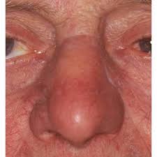 Basal cell carcinoma about 8 out of 10 of all skin cancers are basal cell carcinomas (also called basal cell cancers). Pdf Reconstruction Of Nasal Skin Cancer Defects With Local Flaps