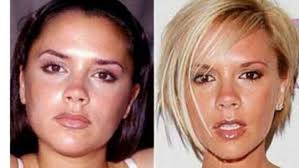 Bichectomía precio, una cirugía cada vez más frecuente. Bichectomia La Tendencia En Cirugia Estetica Que Adelgaza La Cara Y Resalta Los Pomulos Y Es Irreversible