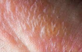 Stress Bumps On Fingers Lovetoknow