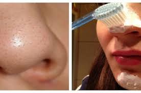 Bersihkan Komedo Dengan Cara Mudah Cukup Siapkan Sikat Gigi Dan Baking Soda Grid