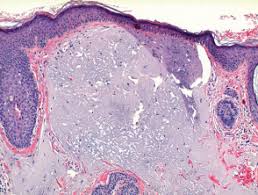 Extracting solar comedones favre racouchot for medical education nsfe. Favre Racouchot Syndrome Pathology Dermnet Nz
