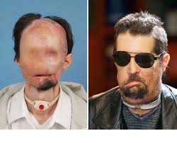 James maki of massachusetts was horribly injured after falling face first into an electrified subway rail. Amazing Face Transplants Graphic Images Cbs News