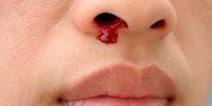 Sangue Dal Naso Cause E Consigli Per Epistassi In Adulti E Bambini Greenme Nose Bleeds Nose Picking Stop Nose Bleeds