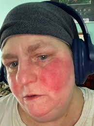 What products can help calm angry skin due to steroid treatment and sinus  infections?