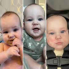 Peanut butter and delayed food allergy in a 6-month-old