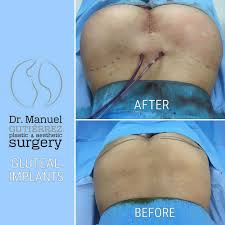 When you don't have enough fat for a bbl:🍑GLUTEAL IMPLANTS! Buttock  augmentation (with implants) is a great option for petite women that are  interested in having the curves that they have always