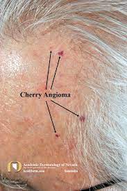 The papules seldom appear on the hands and feet. Cherry Angioma Senile Angioma Academic Dermatology Of Nevada