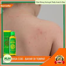 We did not find results for: Obat Biang Keringat Pada Anak Bayi Kulit Gatal Kulit Merah Iritasi Kulit Ruam Merah Shopee Indonesia