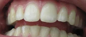 Hyperfluorose Weisse Flecken Bleaching Denta Beaute