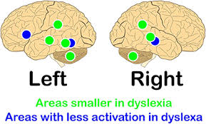 These differences happen in areas of the brain involved with key reading skills. Developmental Dyslexia When The Brain Struggles To Read Frontiers For Young Minds