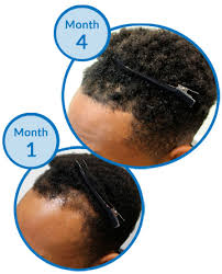 Passing on eclectic braids and color, this simple and natural bush hairstyle makes cute curls its central focus. How Do I Regrow A Thinning Hairline If I Have Afro Hair