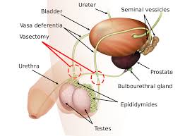 Other awesome resources & websites for anatomy & pose inspiration and reference. Vasectomy Wikipedia