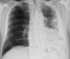 Calcified pleural plaques seen en face have a characteristic rolled edge along their margins, denser than in the central portion of the plaque. Malignant Mesothelioma Radiographics