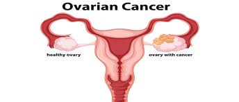 Most epithelial ovarian tumors there are many subtypes of cancerous epithelial tumors. Ovarian Cancer Treatment In Kenya Gynecologist In Nairobi