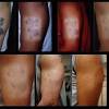 In the earlier days of laser tattoo removal, tattooing on dark skin was a far more difficult task that would often result in scars, hyperpigmentation, or hypopigmentation. 1