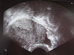 Schwangerschaft 6 Woche 6 Ssw Ultraschallbilder