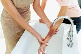 علاج حروق الزيت والتصرف الصحيح حال تعرضك له ثقف نفسك