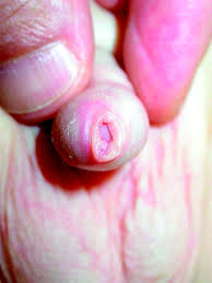 Image result for Phimosis