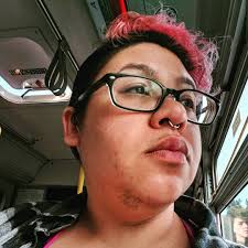 Excessive hair growth in areas in which men usually have hair, as in the face, chest, neck, or tummy, is called hirsutism. Women With Pcos Explain Why They Celebrate Their Facial Hair Allure