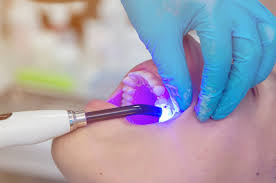 The dentist starts by using a local anesthetic to numb the mouth. Cavity Fillings What To Expect Dental Innovations In Chicago Illinois