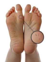 Image result for verruca