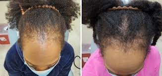 Image result for Alopecia