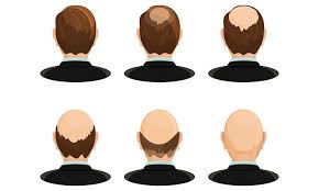 Unlike with men, androgenetic alopecia in women doesn't cause pattern baldness. Can Hereditary Hair Loss Be Cured Dr Batra S