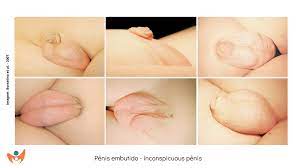 Pênis pequeno / Pênis embutido / Micropênis - Dra. Marilyse Fernandes
